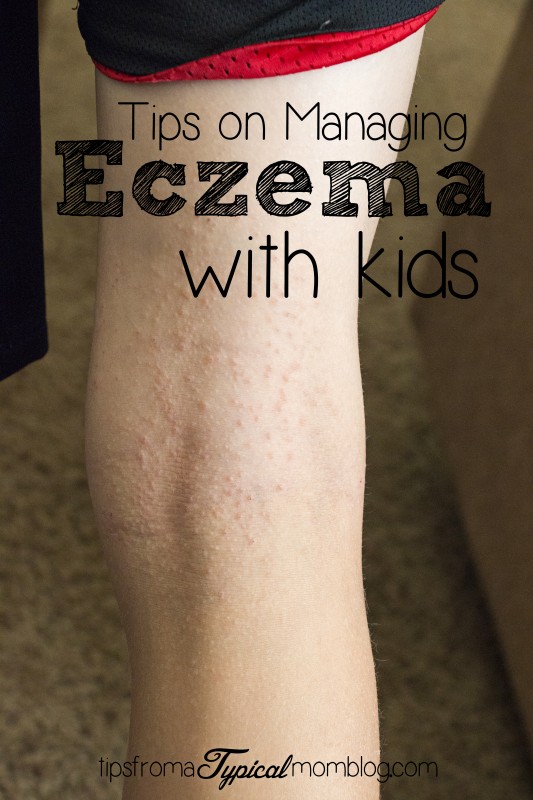 Tips on Managing Eczema with Kids